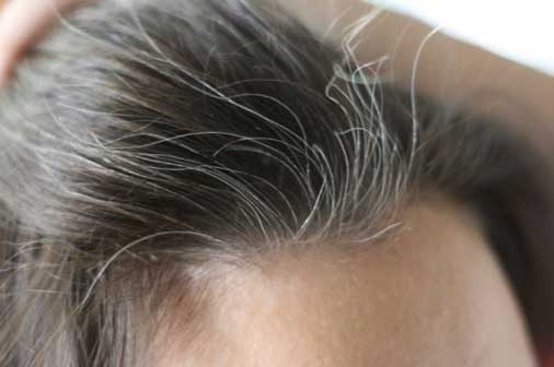 How To Get Rid Of White Hair Naturally Permanent Solution For