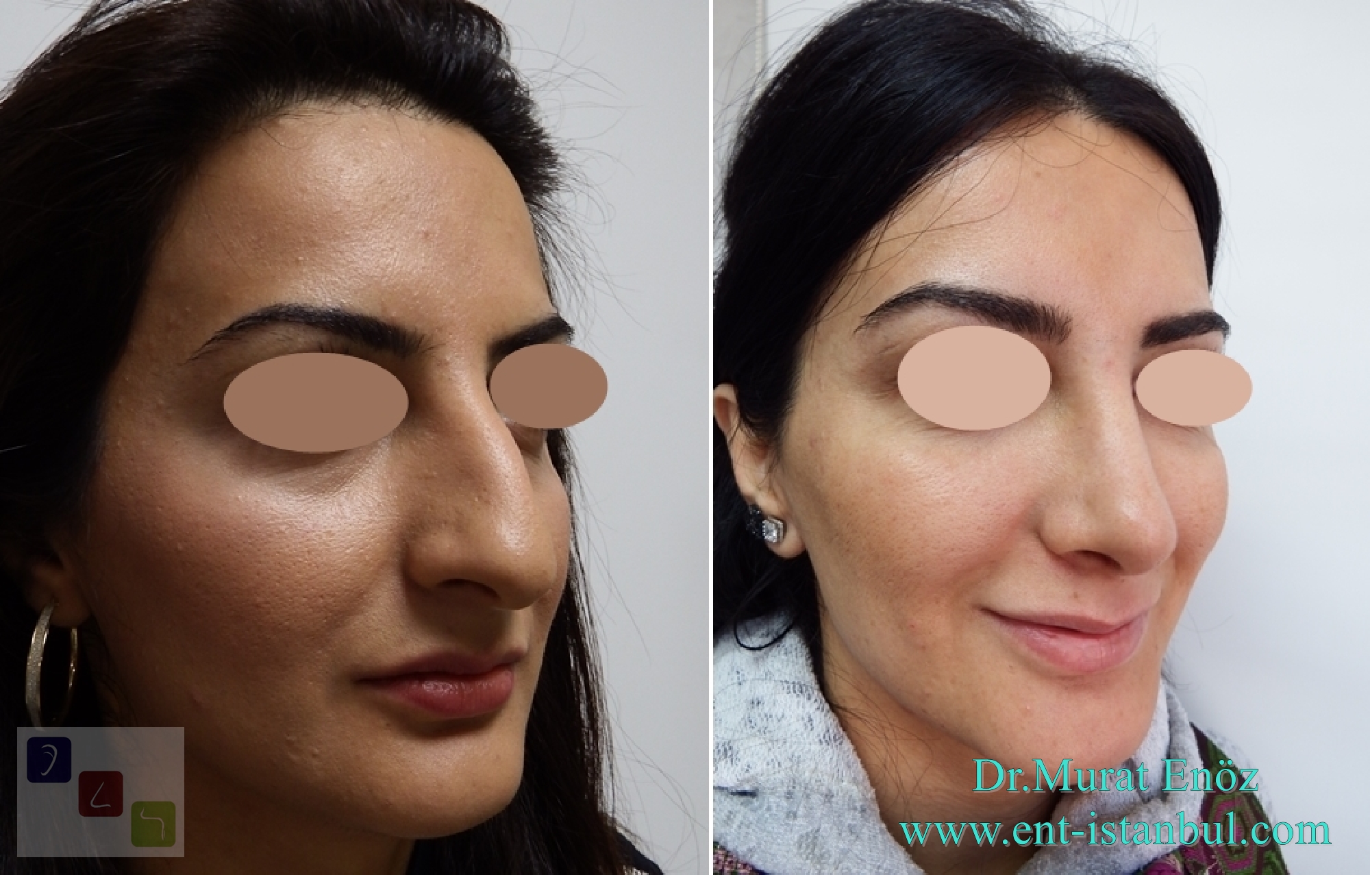 Health Zone Turkey Nose Job in Istanbul, Turkey