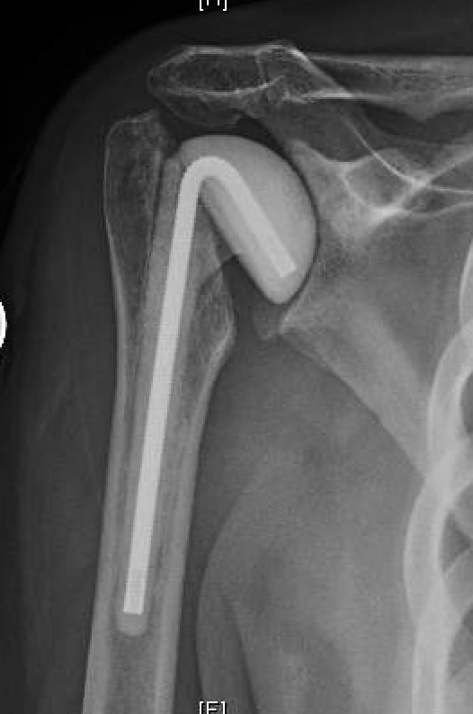 UW Shoulder and Elbow Academy Antibiotic spacer for periprosthetic infection how long can