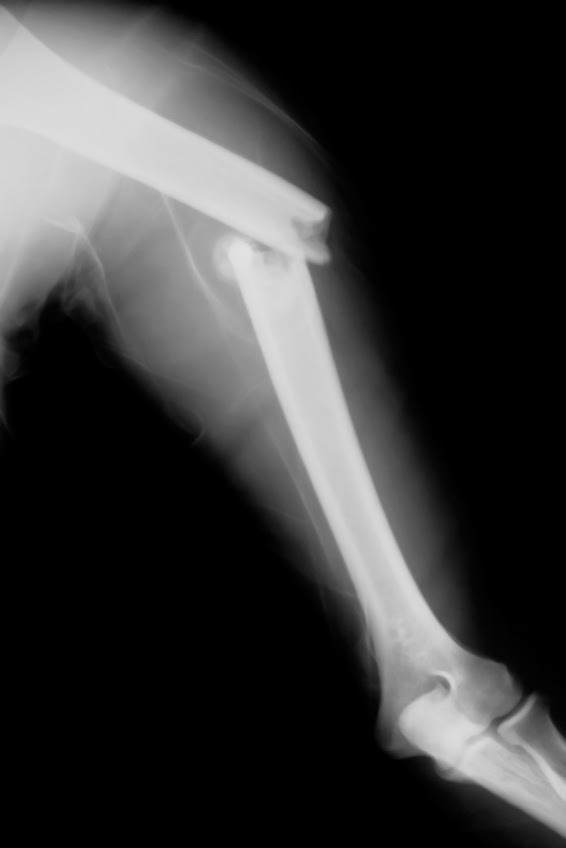 Management of Open Fractures in the Emergency Department 