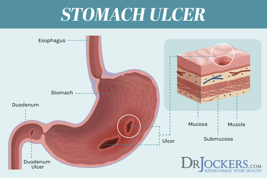 Heal Stomach Ulcer Naturally part 2 Grace Ngo Foundation
