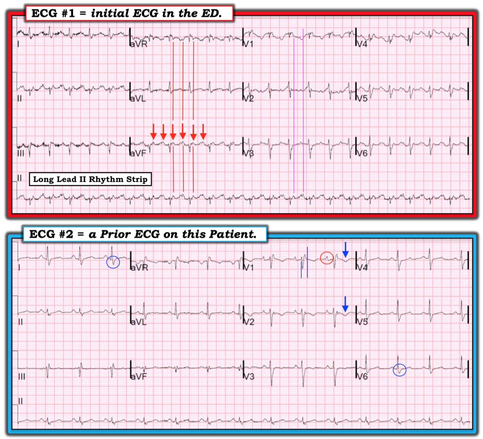 Dr. Smith's ECG Blog Right sided heart failure and tachycardia.