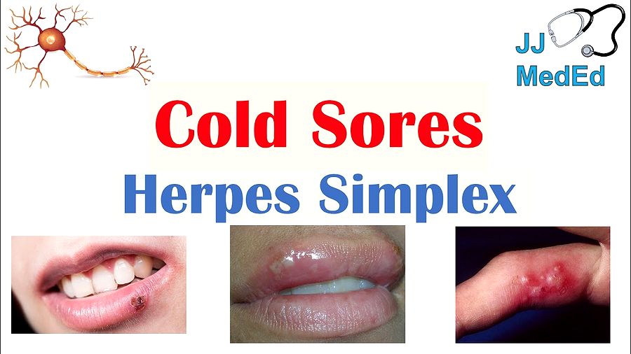 ORAL HERPES. Causes, Signs & Symptoms, Treatment OdontoFarma