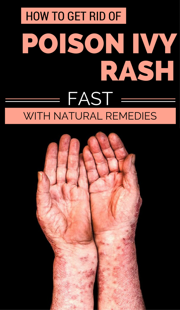 Getting Rid of Poison Ivy Rash Overnight Healthy Lifestyle
