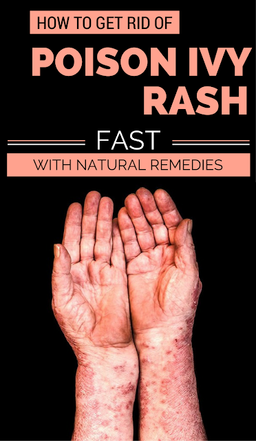 Getting Rid Of Poison Ivy Rash Overnight Healthy Lifestyle