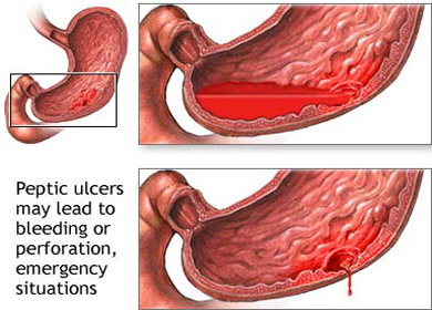 تعرف على أعراض نزيف المعدة