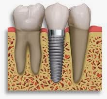 http://www.dentistinchennai.com/implant-procedures.php