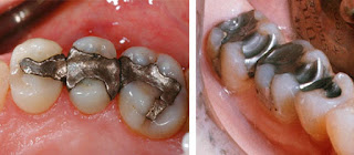 răng sâu bị vỡ lớn có khắc phục bằng trám răng được không