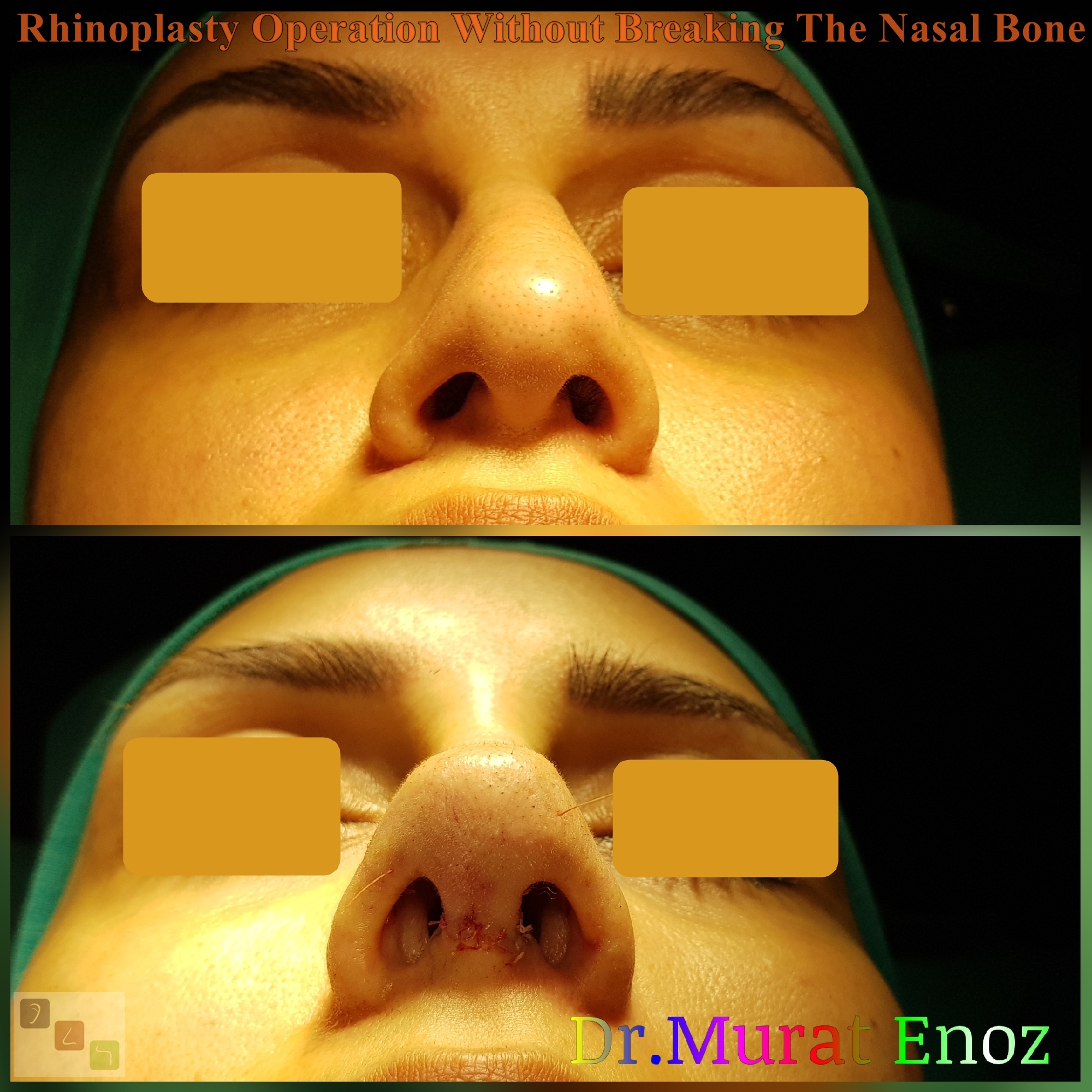 Rhinoplasty Operation Without Breaking The Nasal Bone