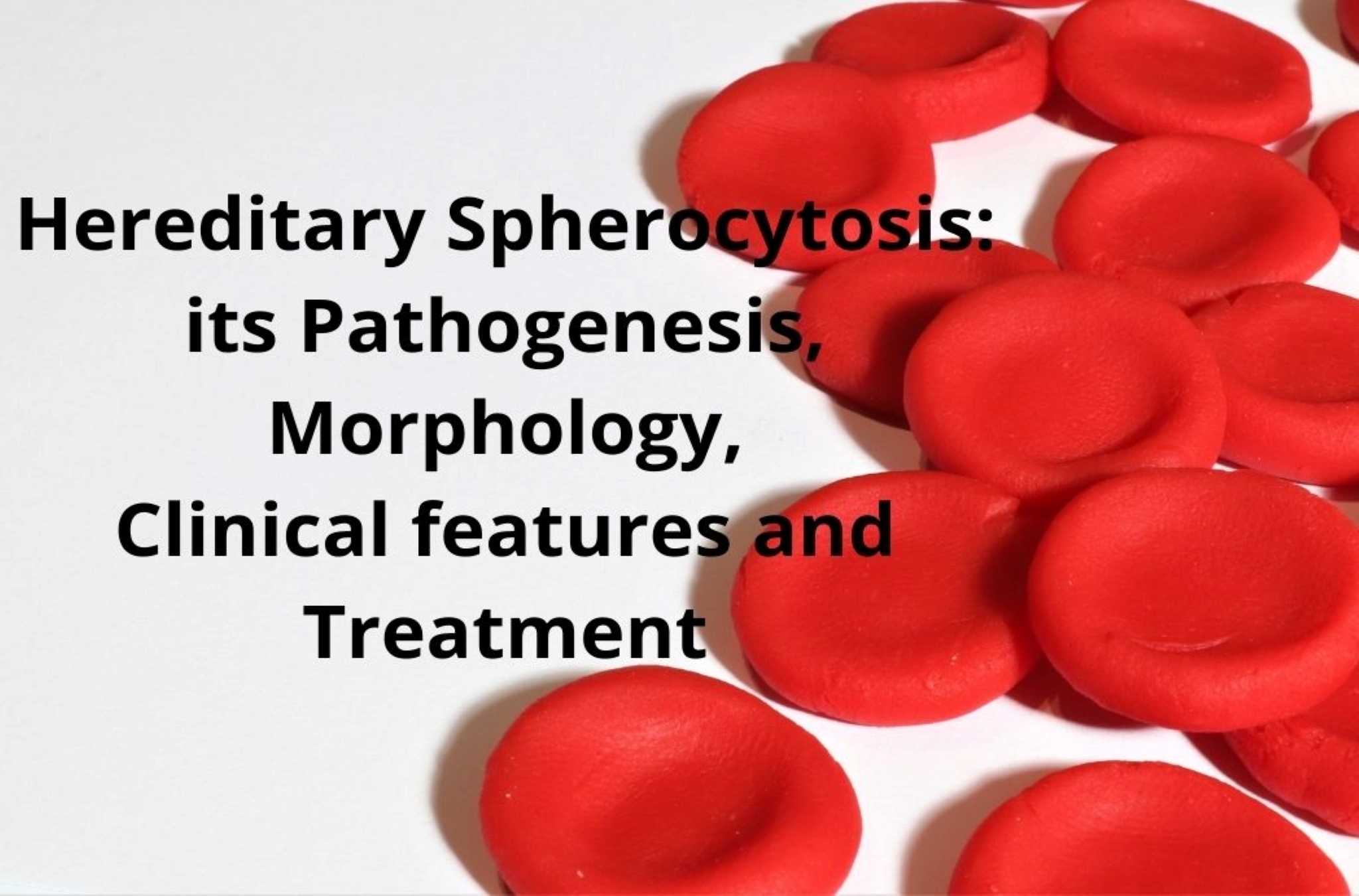 Hereditary Spherocytosis Pathogenesis Morphology Clinical Features hereditary-spherocytosis-pathogenesis-morphology-clinical-features