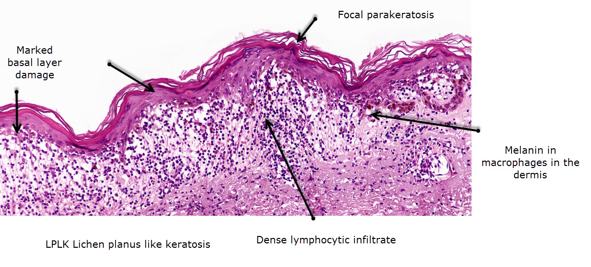 Lichen Striatus: Background, Pathophysiology, Epidemiology