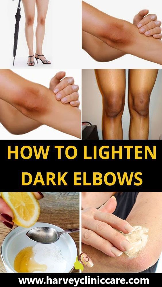 How to Lighten Dark Elbows with Baking Soda Healthy Lifestyle