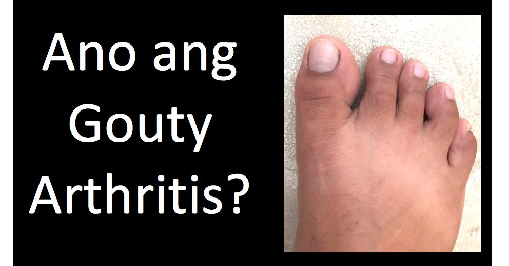 Ano ang Gouty Arthritis? Doctor Genesis Mercado
