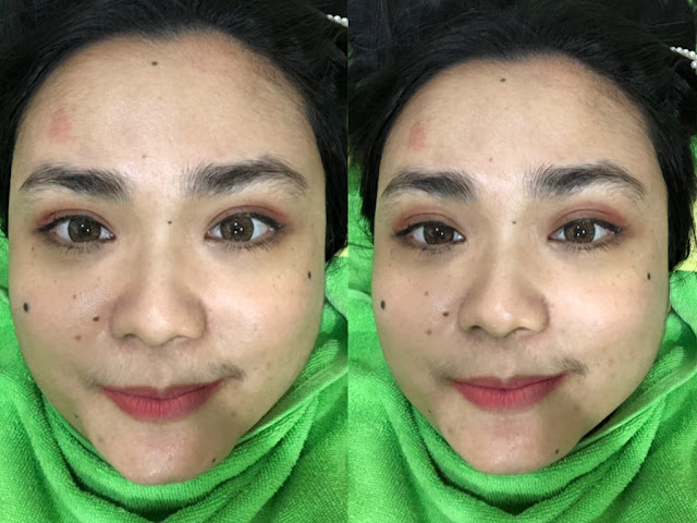 ZAP PHOTO FACIAL GLOW ZAP PHOTO FACIAL GLOW