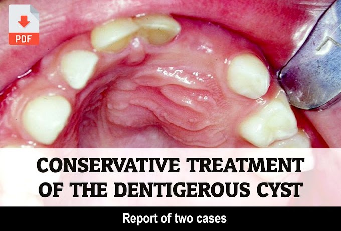PDF: Conservative treatment of the Dentigerous Cyst: report of two cases