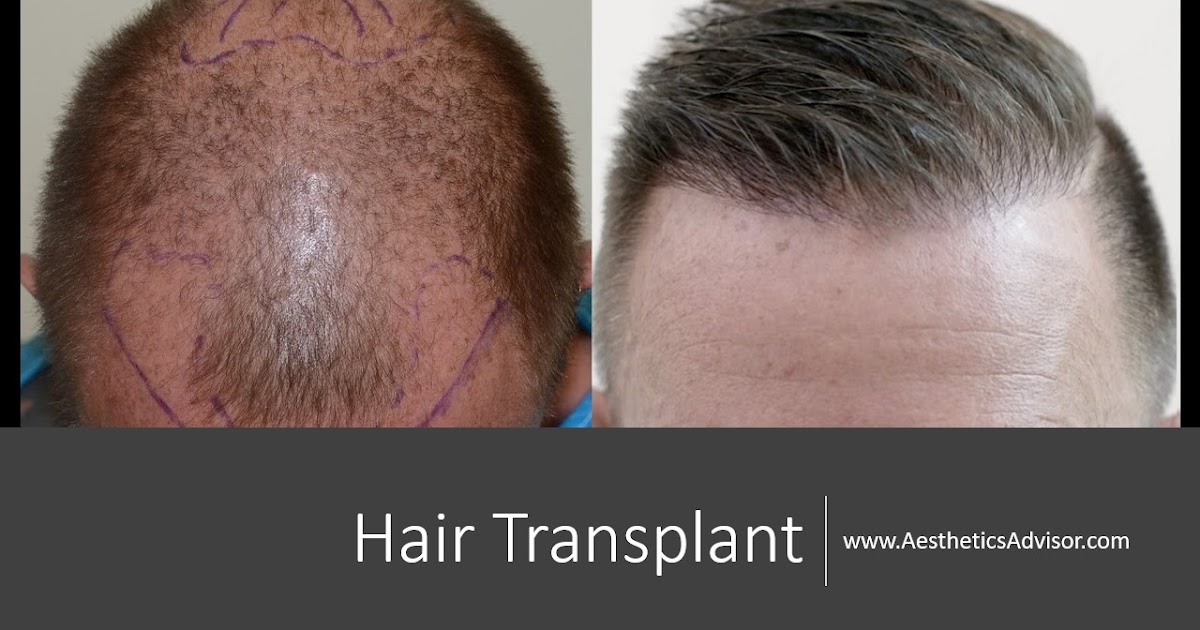 Hair Transplant Malaysia - Check Prices And Reviews 2020 Hair Transplant Malaysia - Check Prices And Reviews 2020