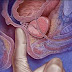 La vitamina d y cancer de prostata prevencion.