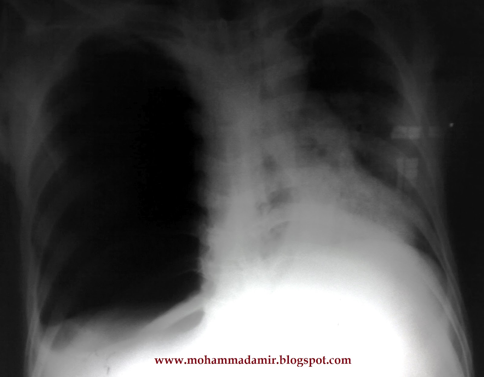 После разрыва легкого. Открытый пневмоторакс рентген. Напряженный пневмоторакс рентген. Пневмоторакс разрыв легкого. Тотальный пневмоторакс рентген.