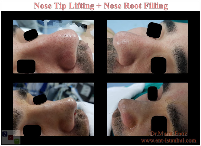 Nose tip lifing in Istanbul,Nose root filling with underskin tissue,Rhinoplasty without breaking the bone, Nose tip plasty in men, Natural nose aesthetic surgery for male
