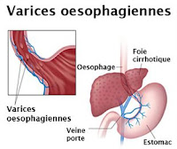 Les varices oesophagiennes