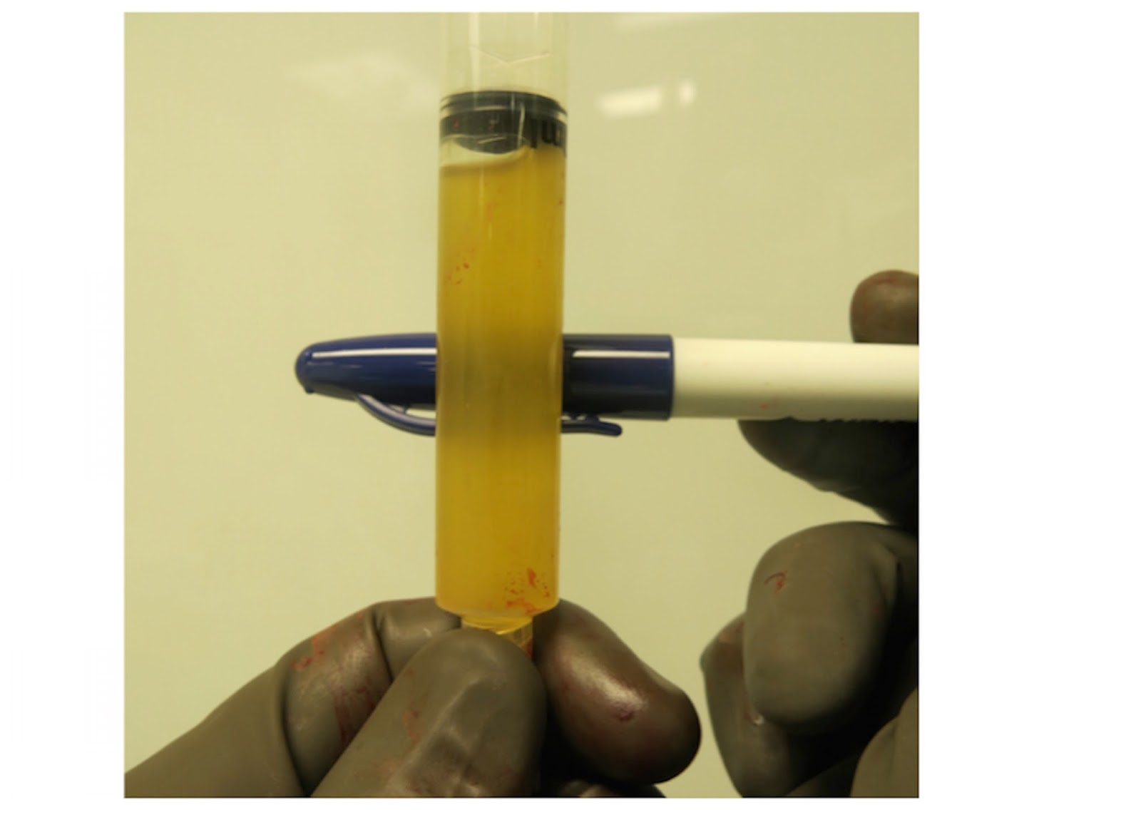 UW Shoulder and Elbow Academy Loose glenoid component is the