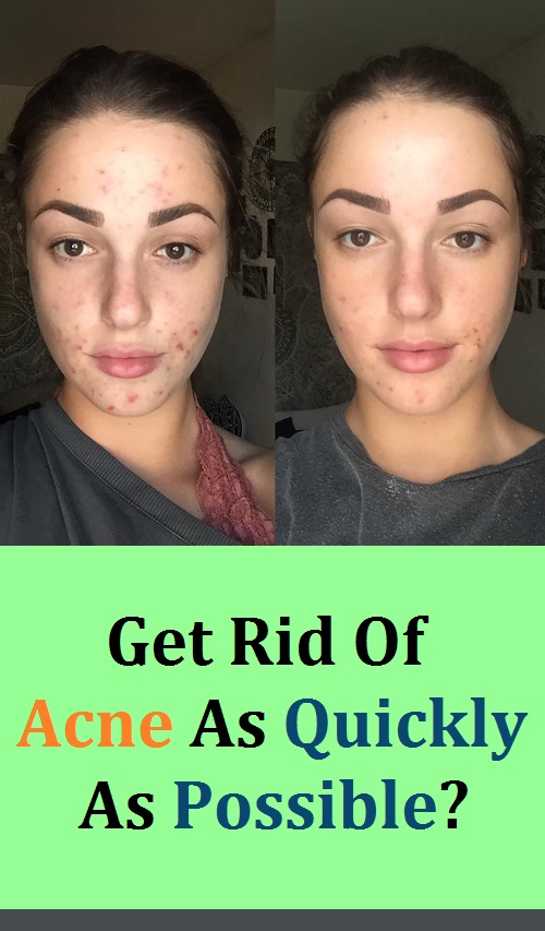 Get Rid Of Acne As Quickly As Possible? Charlotte Moore