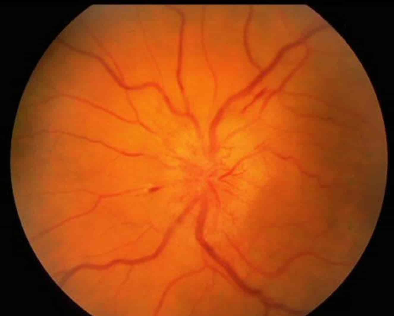 Макулярный отек лечение. Макулярный отек сетчатки. Интраретинальные микрососудистые аномалии. Макулярный отек ретинопатия. Макулопатия макулярный отек.