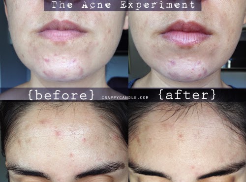 Aztec Healing Clay Mask Before and After :: The Acne Experiment