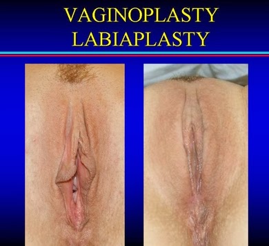 Vaginoplasty, And Labiaplasty, For Sexual Satisfaction