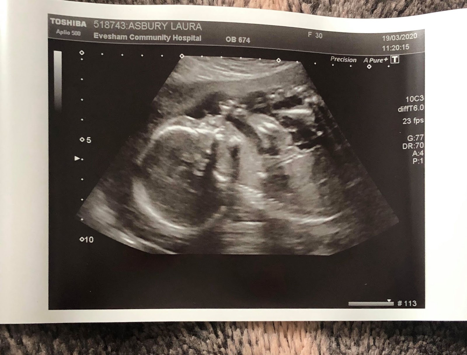 Low amniotic fluid at 20 week ultrasound - sbbasta