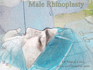 Male rhinoplasty in Istanbul, Nose job for men, Nose aesthetic in men Turkey