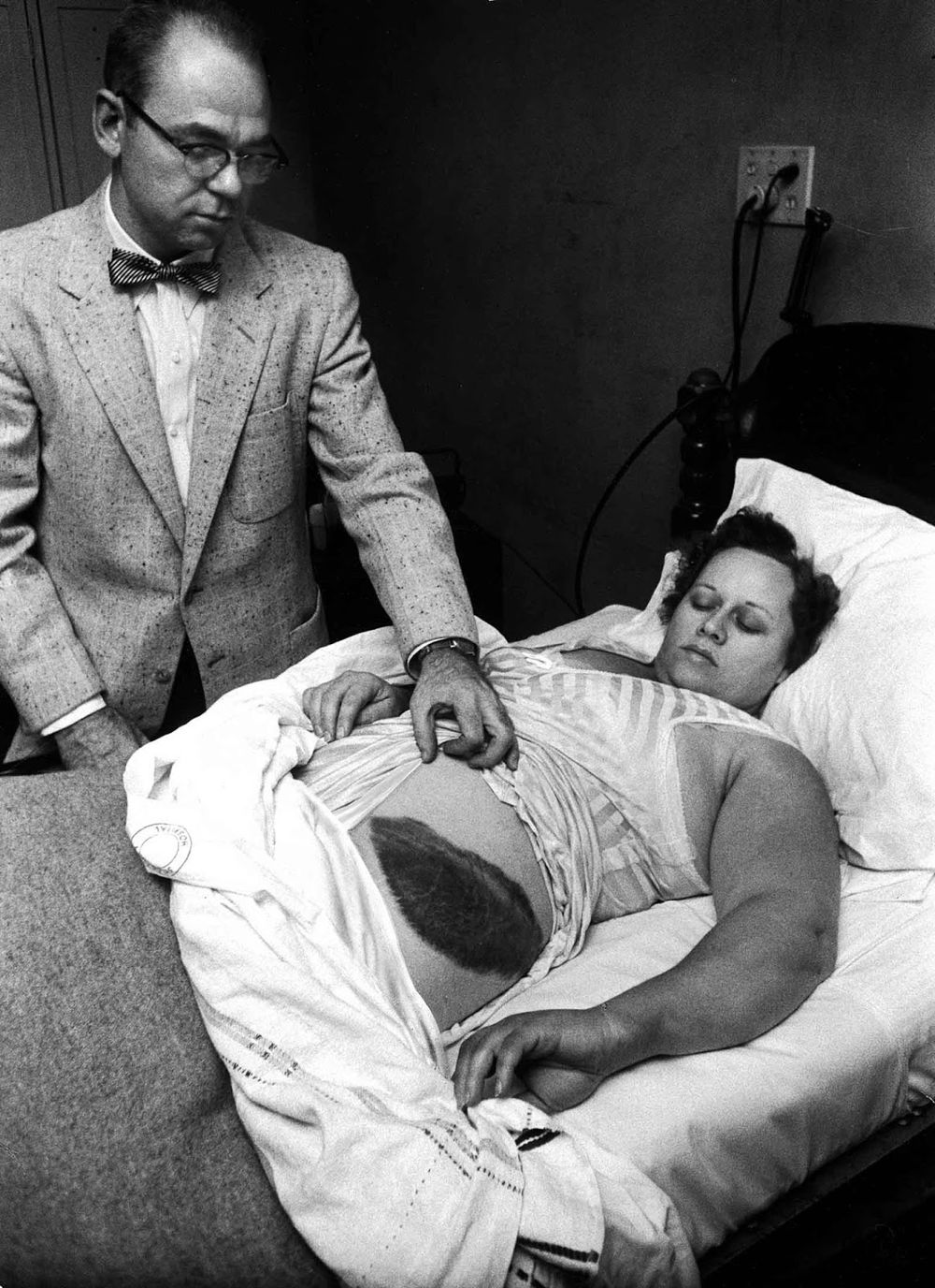 Метеорит попал в женщину. Муди Джейкобс показывает гигантский синяк на боку и бедре своей пациентки Энн Ходжес в 1954 году после удара метеорита.