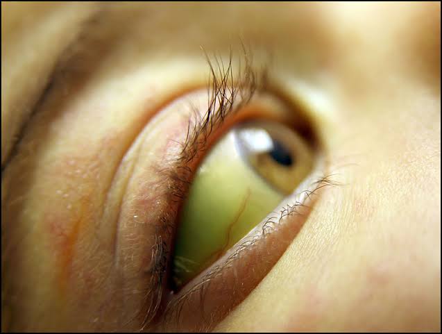 7 facts you need to know about Yellow fever