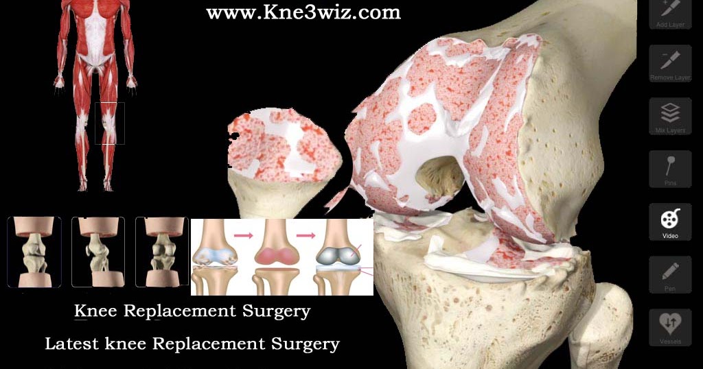 Kne3wiz is best of Knee Replacement. Surgery for Hip Joint with 3d