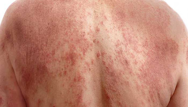 أسباب سرطان الجلد أسباب سرطان الجلد