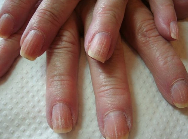 What causes black lines in fingernails? | Reference.com