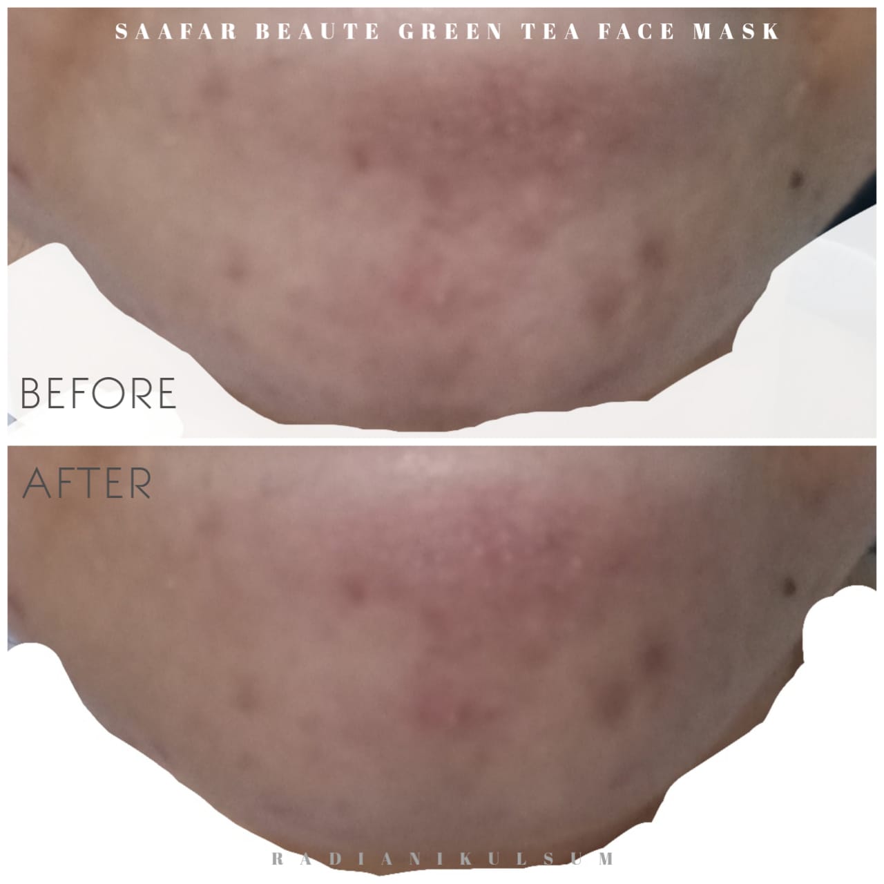 before-after pemakaian Saafar Beaute Green Tea Face Mask di dagu