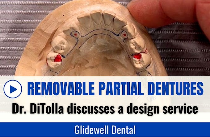 REMOVABLE PARTIAL DENTURES: Dr. DiTolla discusses a design service