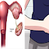 Girls and Women Age 18-44: Should Be Aware With Polycystic Ovarian Syndrome or PCOS
