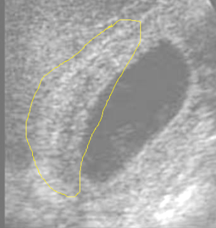 uLTRASOUND hEPATITIS ultrasound hepatitis