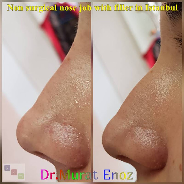 Non-surgical rhinoplasty in Istanbul - The 5 Minute Nose Job in Istanbul - Non-surgical nose job - Nose filler injection Turkey - Injectable nose job - Liquid rhinoplasty