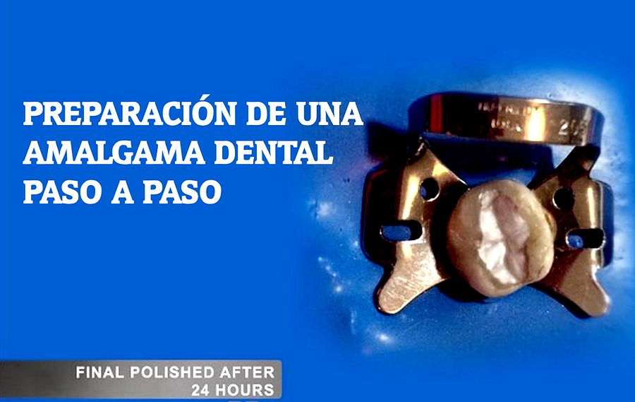AMALGAMA DENTAL Preparación Paso a Paso