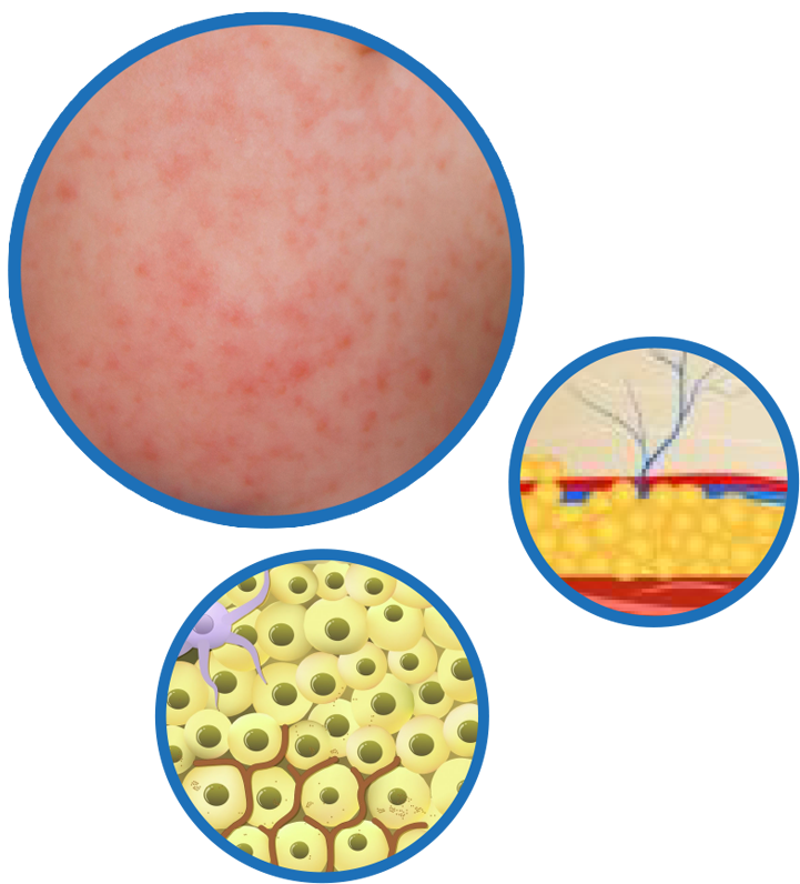 Tips Liburan untuk Anak Penderita Dermatitis Atopik Dian Restu