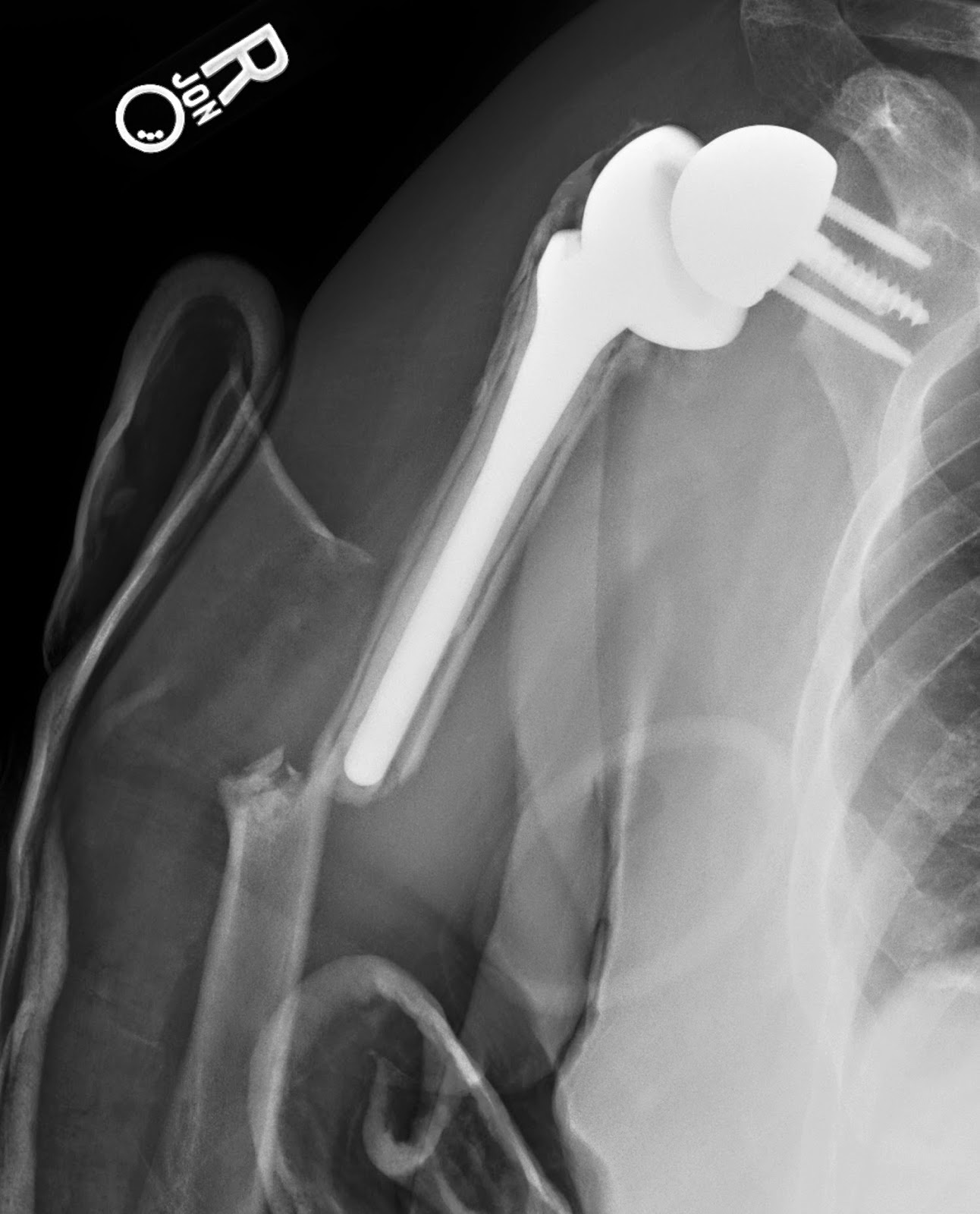 Shoulder Joint Replacement Surgery Incision – EFNFA