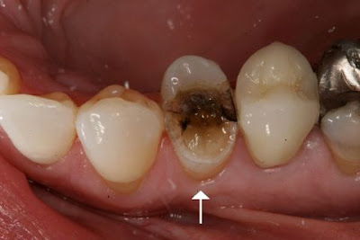 Răng sâu bị hôi bạn nên điều trị ngay tại nha khoa-2