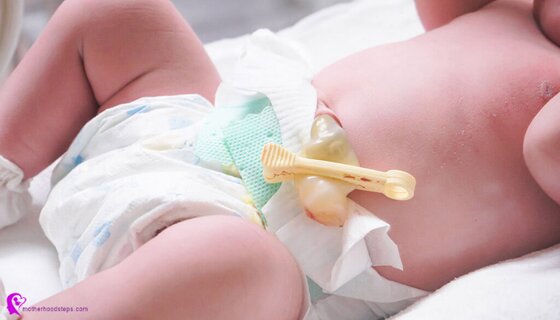Umbilical Cord Care In Newborn