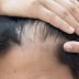 How Much Hair Fall Is Normal And How To Prevent Excessive One
