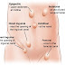 What is the cause of Hernia - Hernia Best Natural Remedies here..