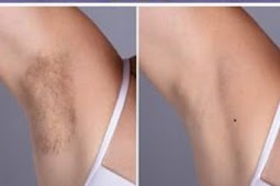 HOW TO REMOVE BODY HAIR PERMANENTLY WITHOUT SHAVING OR WAXING