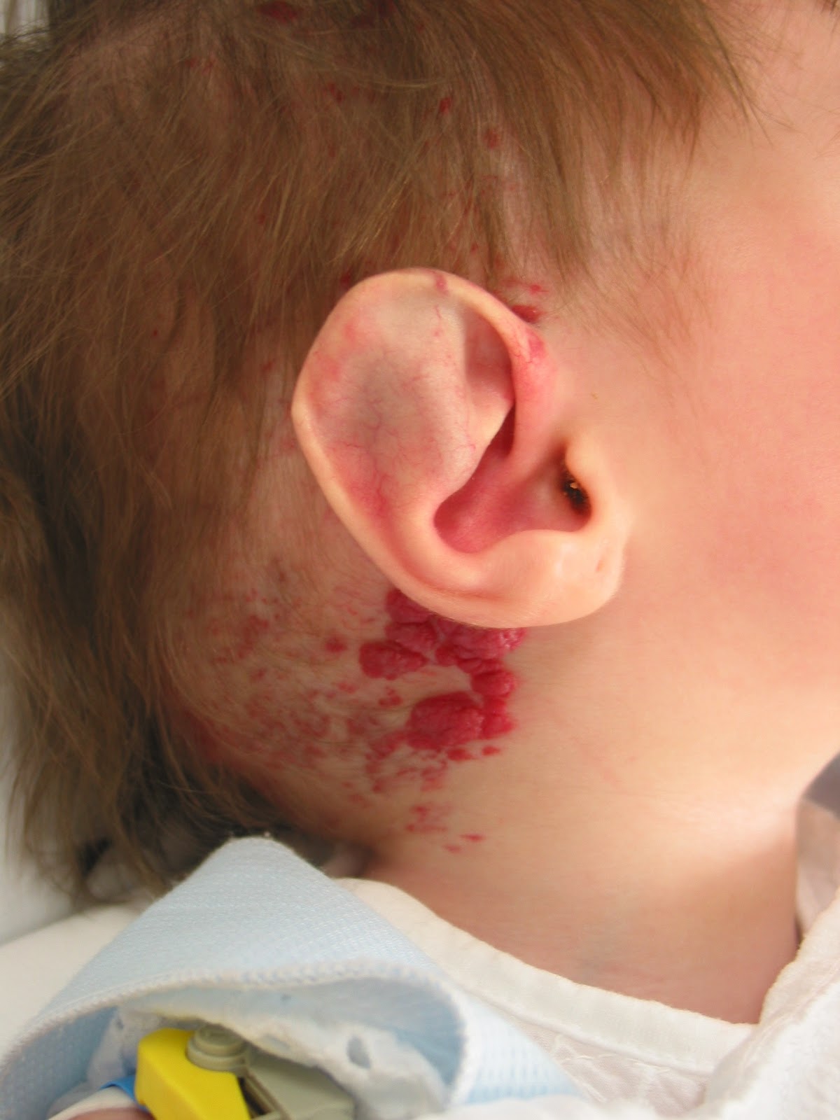 Initiation and Use of Propranolol for Infantile Hemangioma ...